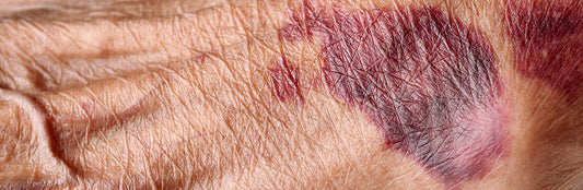 Skin Tear on arm