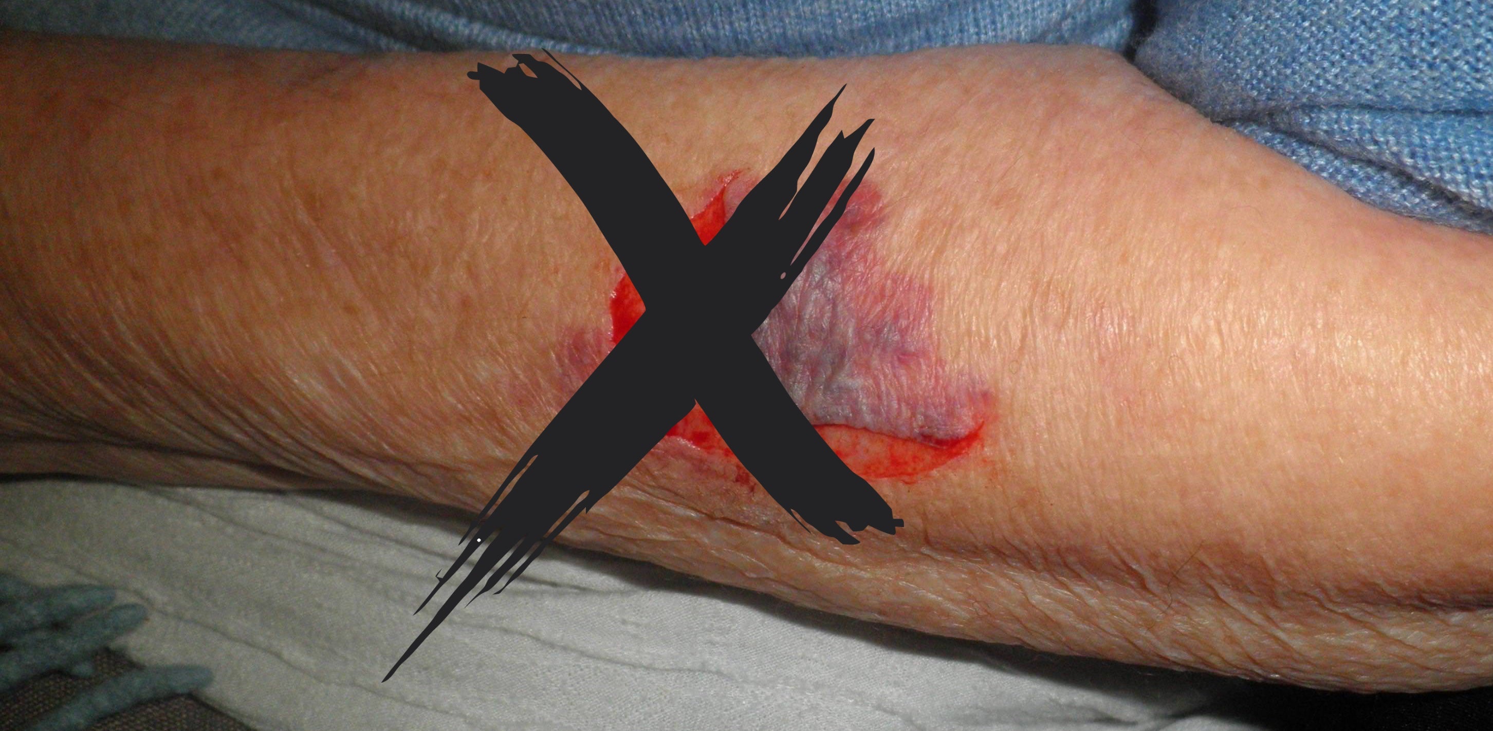Eliminate skin tears on frail or fragile skin